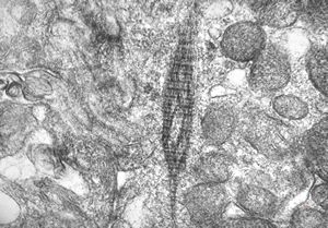 F,5y. | immotile cilia syndrome - rootlet of kinocilia